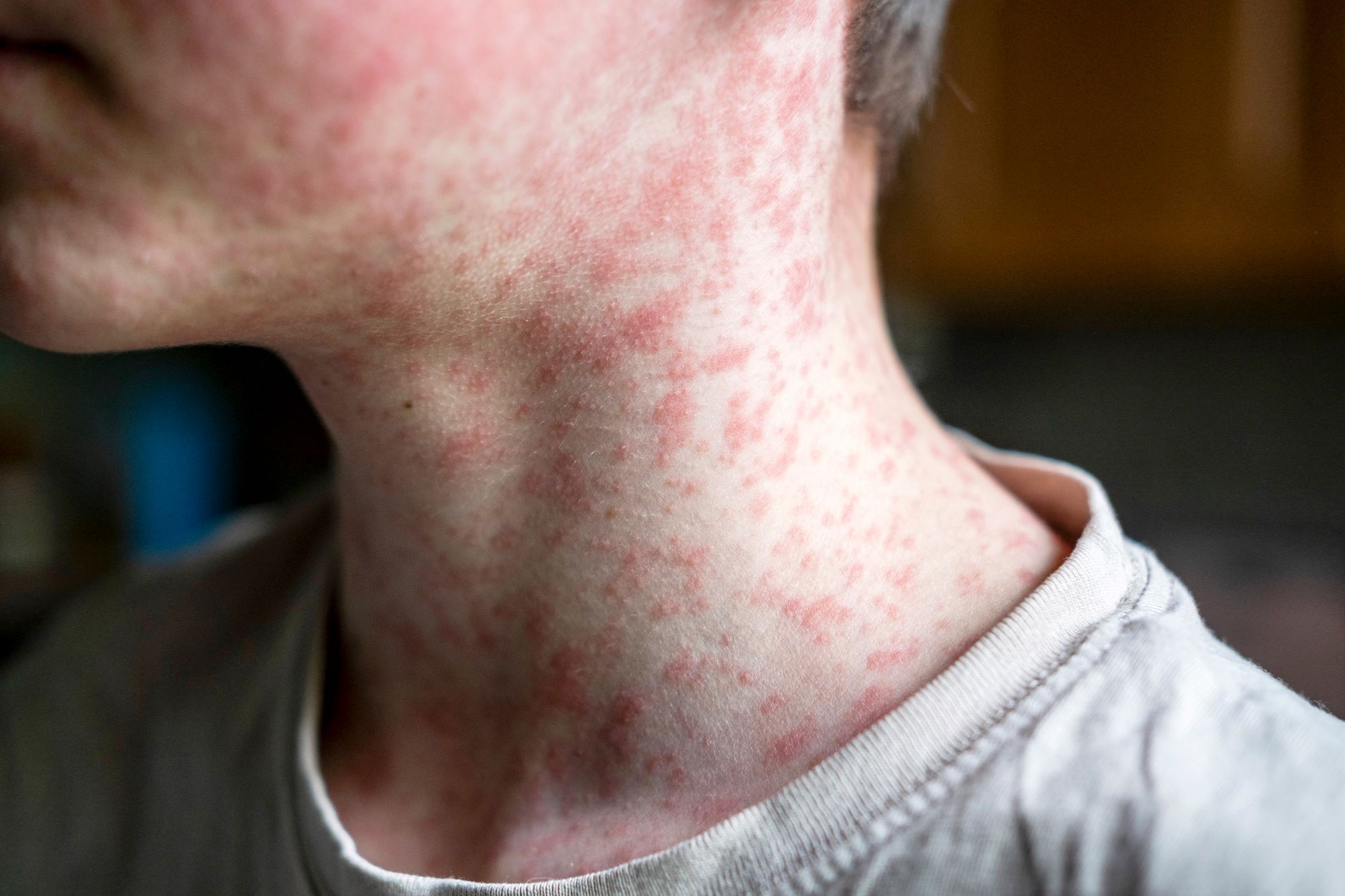 kid with measles